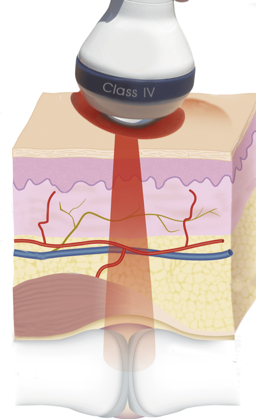 Laser Treatment